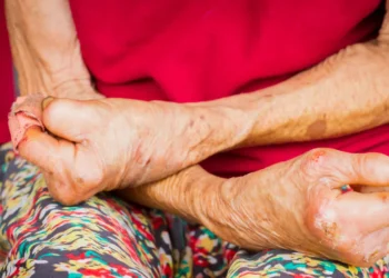 Xorvatiya və Rumıniyada 32 və 44 ildən sonra ilk cüzam halı aşkar edilib