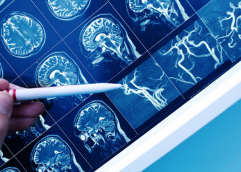 Ağır epilepsiyanın müalicəsində yeni bir yanaşma kəşf edilib
