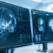 Alzheimerin erkən dəyişikliklərini bloklayan dərman kəşf edilib