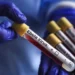 Ölümcül Ebola virusu xəbərdarlığı artır! Ölüm sayı 100-ü keçdi!