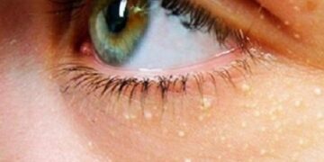 Üzdəki bu əlamət infarkt və insult riskinə işarə edir